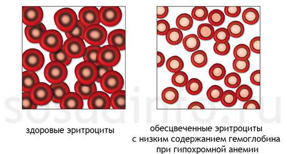 Серповидно клеточная анемия картинки