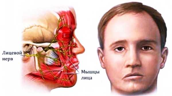 Лицевой нерв где находится у человека фото признаки и лечение