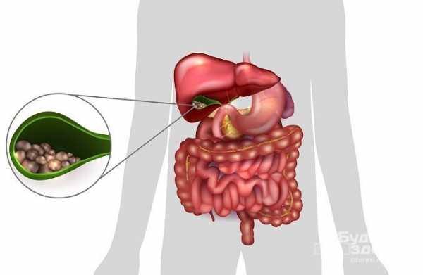 Хронический холецистит картинки