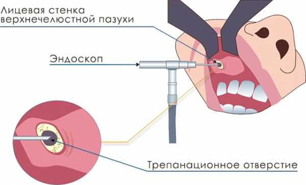 Нарушение носового клапана