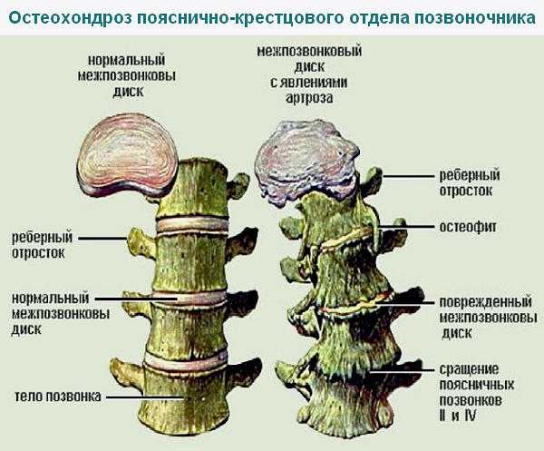 Дорсопатия на фоне остеохондроза позвоночника