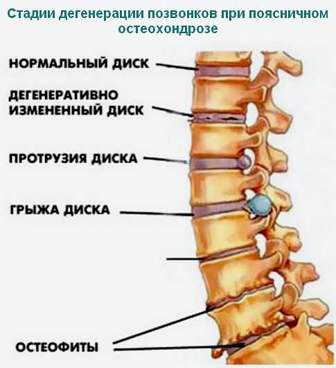 Остеофиты позвоночника поясничного отдела фото