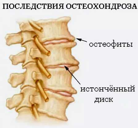 Остеохондроз поясничного отдела позвоночника карта вызова шпаргалка