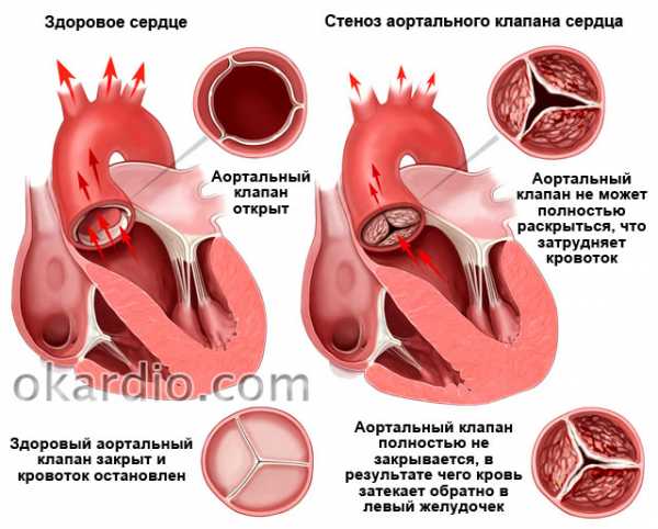 Симптомы при болезни сердца – Признаки заболевания сердца: симптомы и