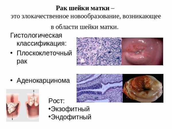 Эрозия шейки матки симптомы и признаки фото