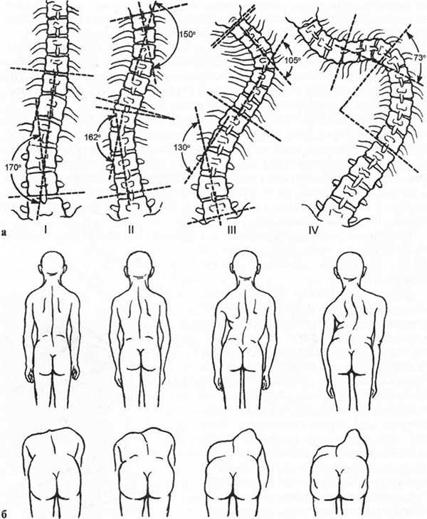 Степени сколиоза по градусам фото
