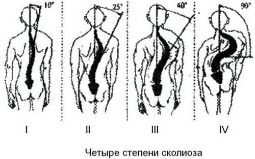 Схема тейпирования спины при сколиозе