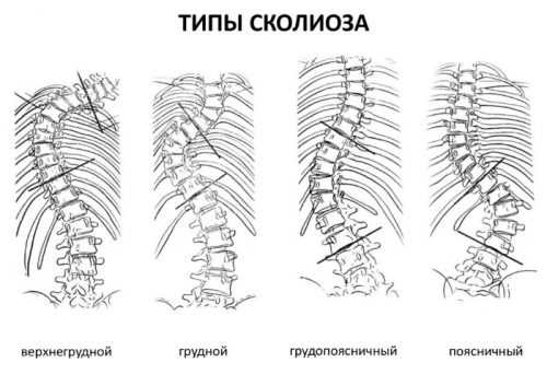 Инверсионный стол при сколиозе 3 степени