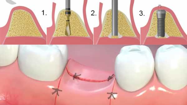 Этапы имплантации зубов схема по времени