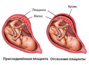 Сколько времени после родов кровит – дней, длится в раннем послеродовом