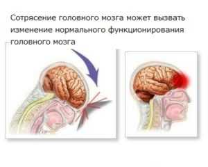 Сотрясение мозга карта вызова