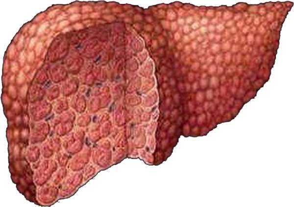 Цирроз печени последняя стадия фото