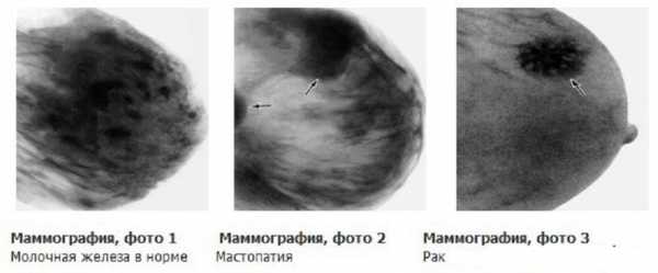 Терминальная стадия рака молочной железы фото