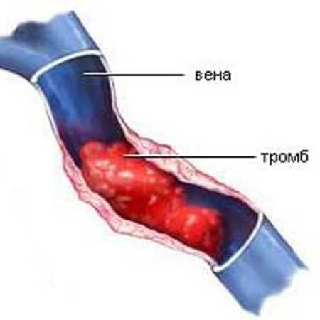 Тромбоз вены на руке фото