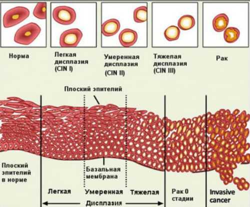 Дисплазия шейки матки картинки