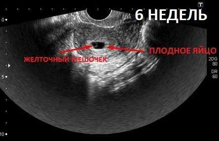 Выкидыш на 7 неделе беременности фото