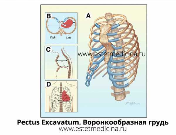 Воронкообразная грудь фото