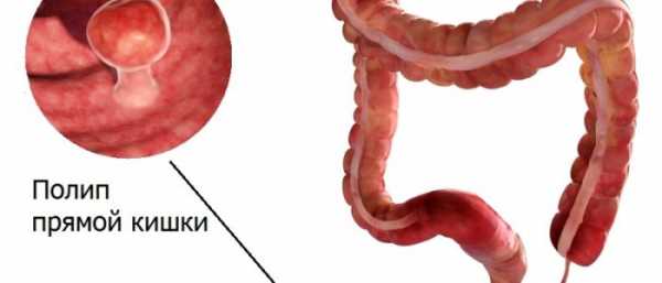 Полип в слепой кишке что это может быть