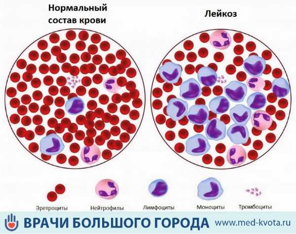 Картина крови при раке крови