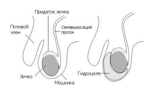 Причины водянка яичка у мужчин фото