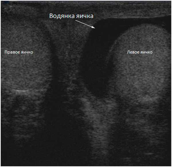 Водянка яичка узи фото