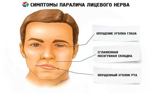 Воспаление тройничного нерва на лице симптомы и лечение в домашних условиях фото