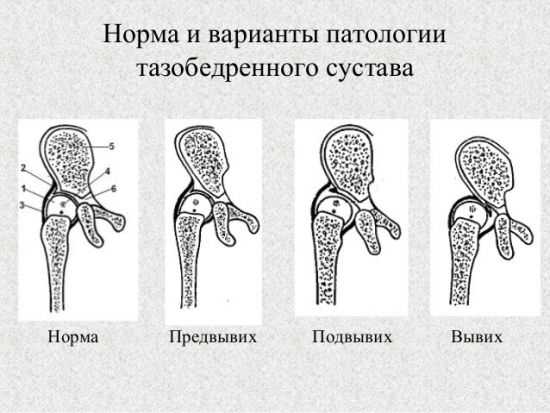 Фото тазобедренного сустава у женщин после 50