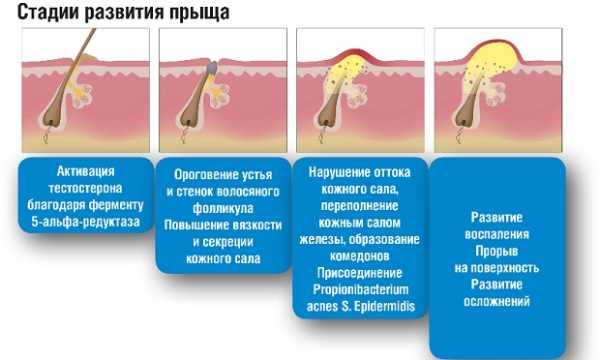 Розацеа стероидная схема лечения у женщин