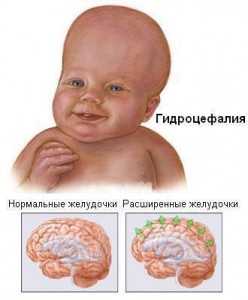 Картина наружной заместительной гидроцефалии