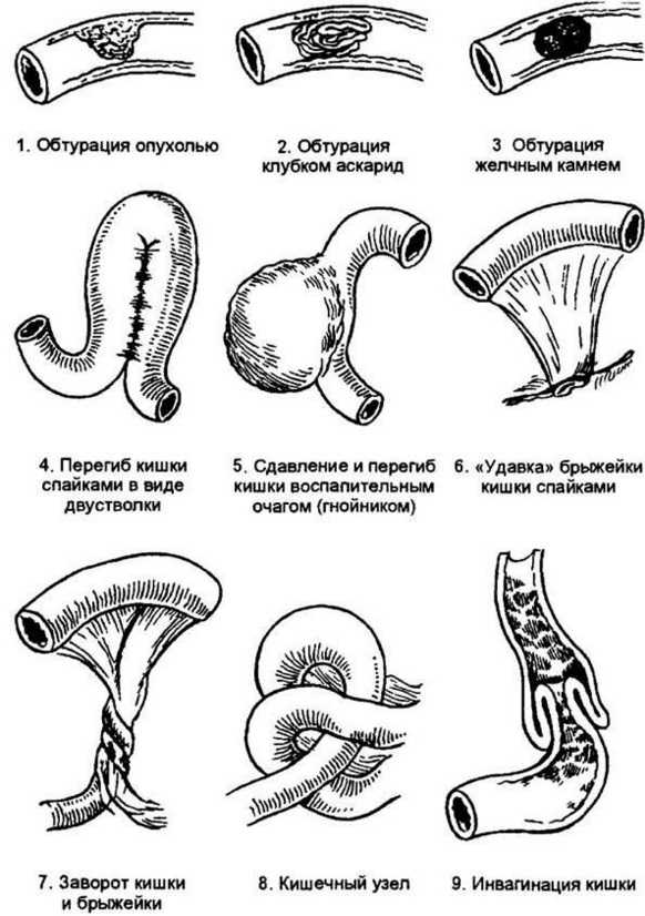 Каловые массы в кишечнике фото