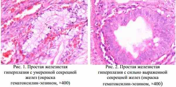 Гиперплазия миндалин фото