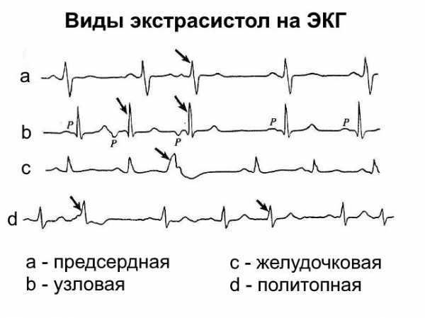 Желудочковая экстрасистолия на экг фото