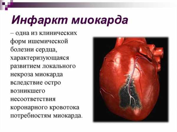 Можно ли выжить после инфаркта